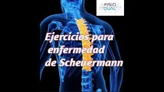 Ejercicios para enfermedad de Scheuermann