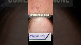 Pakistani pharmacy products that work best for skin #reels #azelaicacid #viralproduct  #reelscreator