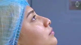 &iquest;Como son los resultados de la Rinoplast&iacute;a L&aacute;ser?