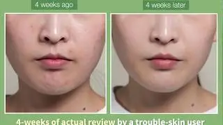 Somebymi Miracle Serum 4 weeks review B & A 💧 (eng)