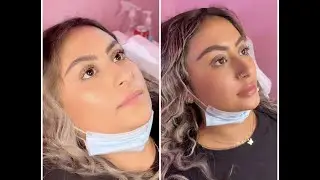 Lip Filler Vlog | Start to Finish with Needless Lip Filler