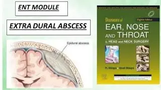 ENT- complication of csom - Extradural abscess #ear #dhingra #abcess  #ent #pain