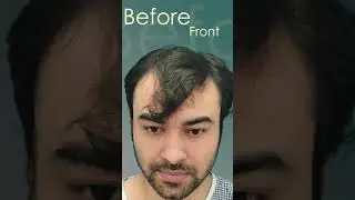 {2024) Hair Transplant Results Frontal + Crown #shorts