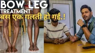 Learn from Mistake during bow leg correction. Dr.Akash shetty( tamilnadu) fixed bow legs in Mumbai.