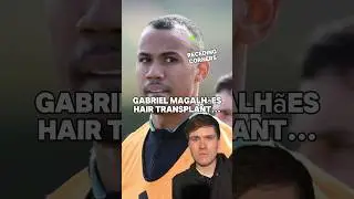 Gabriel Magalh&atilde;es hair transplant! 🔥