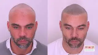 Scalp Micropigmentation Client Testimonial - GiveGoodFace London