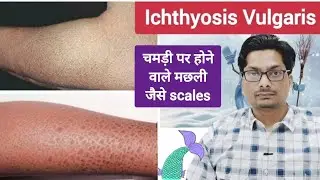 Fish-like scales on the skin | Ichthyosis Vulgaris | Itchy, dry fish-like skin #ichthyosis