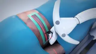 DEMCON - CT compatible needle positioning system