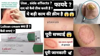 lulican cream |lulican cream uses in hindi|  luliconazole cream |dad khaj khujli best medicine
