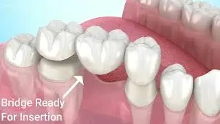 Replace missing teeth with dental bridge to restore function.