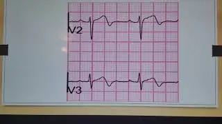 Advanced EKG Interpretation