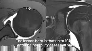 Case Report: HAGL Injury in Shoulder Instability