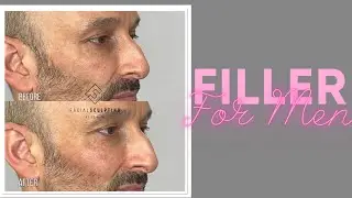 Филлер для мужских щек: до и после от доктора Нины Бал 💕 Филлер для мужских щек с естественным ре...