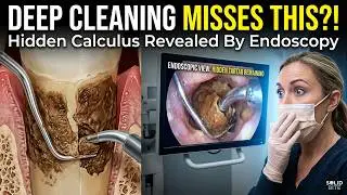 Periodontal Endoscopy: See What Deep Cleaning Misses