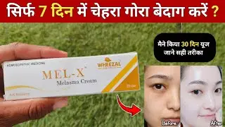 Mel x melasma cream | mel x melasma cream review | mel x melasma cream use kaise kare 