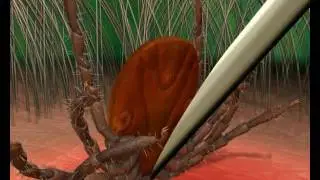 Kullancs kiszed&eacute;se steril tűvel - computer anim&aacute;ci&oacute;