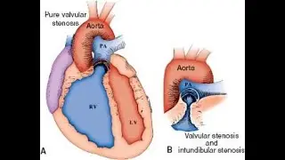 Infundibular And subvalvular stenosis types of pulmonary stenosis, narrowing that obstructs blood