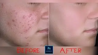 How to Remove Acne in Photoshop