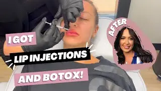 LIP FILLER AND BOTOX VLOG || come along with me - before and after