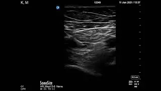 Saphenous (adductor canal) block - identifying and needling