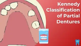 Kennedy Classification of Removable Partial Dentures | A QUICK and EASY Classification