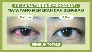 Mata Merah dan Bengkak? Jangan Panik! Ini Cara Cepat Mengatasinya!