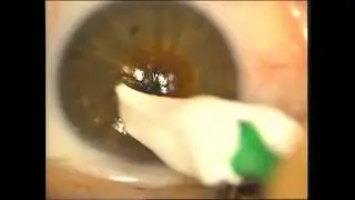 Advanced Surface Ablation - Eye Surgery