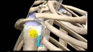 Anatomía Radiológica para estudiantes:  Hombro 3 (RM Oseo y Ligamentoso)
