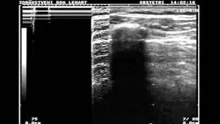 Normal lung vs. pneumothorax