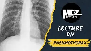 Pneumothorax Explained | Types, Causes, and Management | MRCS A & Medical Students