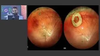 KSOS 2025   IC1   A to Z of Retinal Lasers for Comprehensive Ophthalmologists
