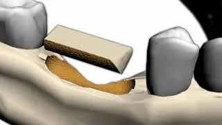 Transfer-Control (Horizontale und Vertikale Knochenblock-Transplantation),CTR00