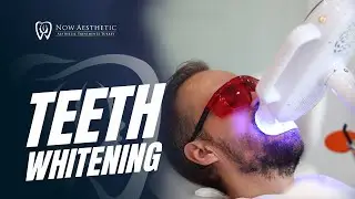 Teeth Whitening! I Now Aesthetic