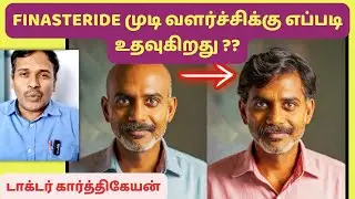 இந்த முடிவளர்ச்சி சாத்தியமா? | Finasteride Hair loss treatment