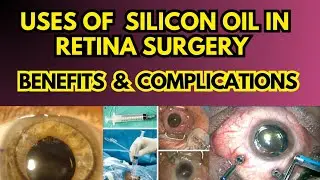 Silicon oil in Retinal detachment surgery | Benefits vs Side Effects | Dr Faisal Anwar