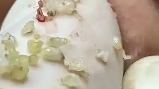 Extreme Blackhead Removal | Deep Pore Cleaning & Satisfying Extraction #4000