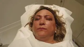 Lidlifting bei Amenta Cosmetic Karlsruhe - Faltenbehandlung