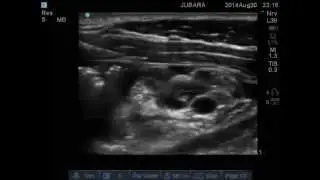 donut medial cord