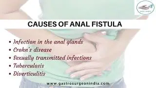 Treatment for Anal Fistula in Hyderabad | Gastroenterologist in India | Dr. Parthasarathy