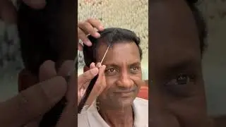 Actor Rohit Chavan&rsquo;s Incredible Hair Transplant Journey &ndash; 6 Months Results!