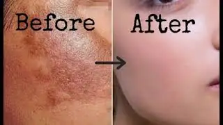 Natural chemical Free Beauty products Pigmentation dark cerkal Pimple Removing Products 