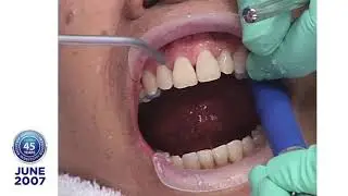 Dr. Robert Ibsen Presents Gwyn C., a Lumineers&reg; Clinical Case Presentation: 2007