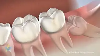 Wisdom Teeth Removal with Dr. Phillips at Park Cities Oral & Maxillofacial Surgery Associates