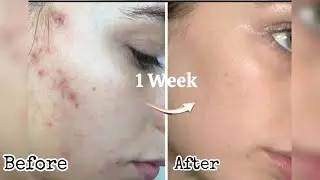 ✨No More Acne✨|| Best Acne Mask