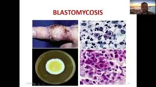 Systemic mycosis