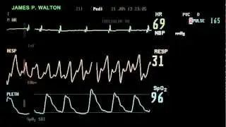 ECG / EKG Monitor Stock Footage