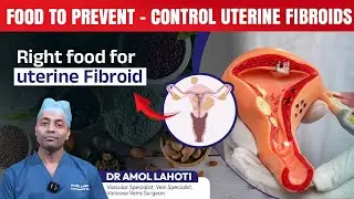 Best Diet for Uterine Fibroids | Foods to Eat & Avoid (Doctor Explains)