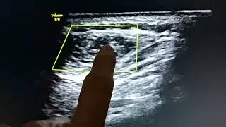 Intramuscular Benign Tumour possibly Desmoid Tumour: Ultrasound Appearances