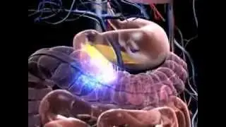 SamiDirect With ( Kapil 09814764328 ) Animation about diabetes