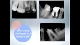 062 Semana ADM en I+D: La Endodoncia Exitosa al día de hoy - 